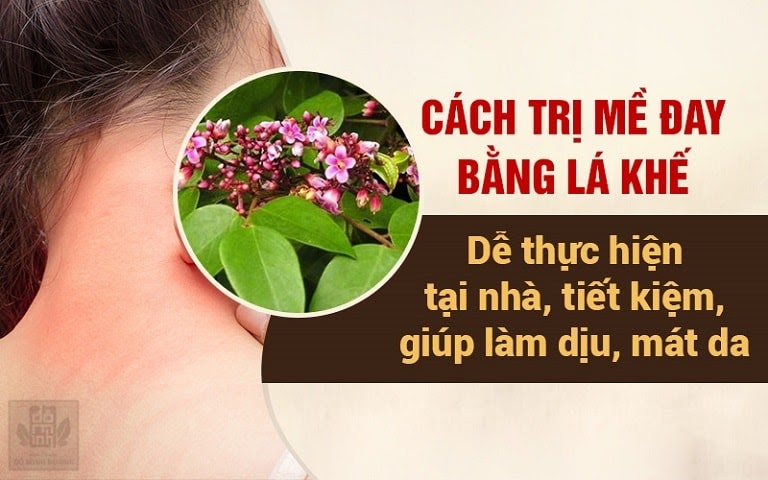 Cách chữa nổi mề đay dân gian tại nhà bằng lá khế