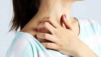 Nổi mề đay sau sinh