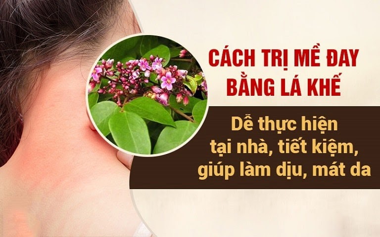 Chữa mề đay bằng lá khế là cách đơn giản dễ thực hiện tại nhà