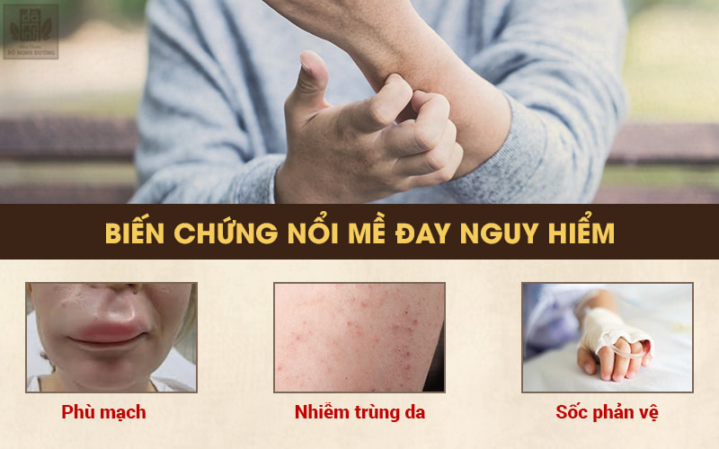 Bệnh mề đay cần chủ động điều trị sớm tránh biến chứng