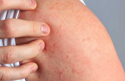 Nổi mề đay ở tay là bệnh dị ứng da khá phổ biến