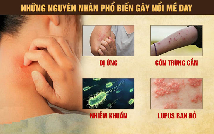 Nguyên nhân gây nổi mề đay