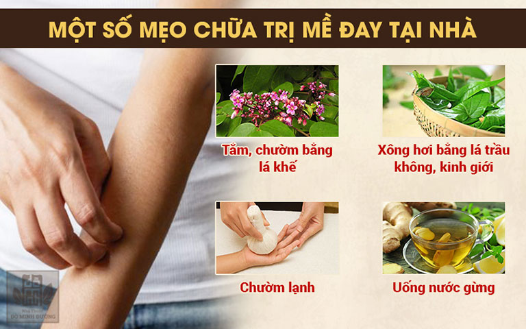 Những mẹo dân gian chữa mề đay được ưa chuộng nhất