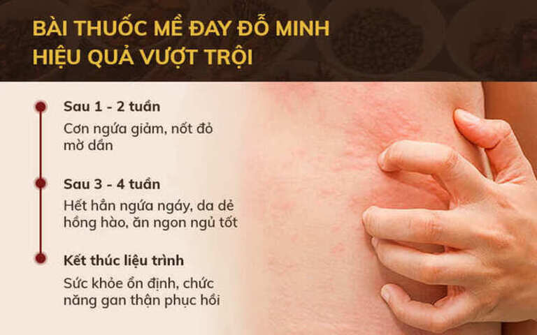 Hiệu quả bài thuốc Mề đay Đỗ Minh theo từng giai đoạn điều trị